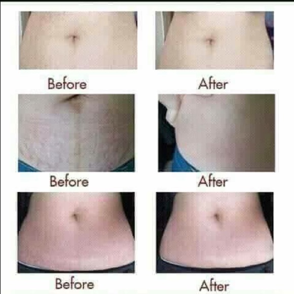 Scarless Cream Acne Stretch Mark Pimple Marks - Picture 7 of 8